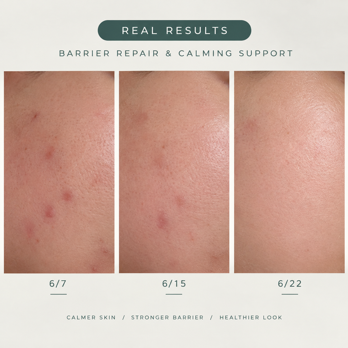 Calm Stinging, Tight, Flaky Skin in 2 Weeks With Dual-Source Barrier Repair